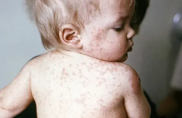 У дзіцяці адзёр /&nbsp;klinikaexpert.ru
